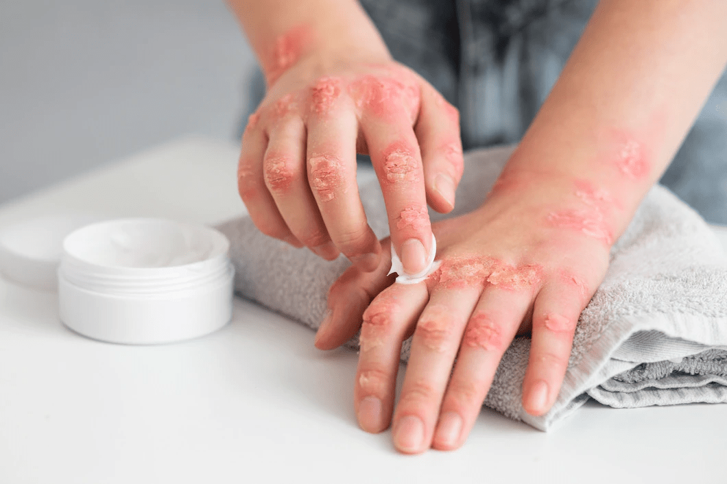 Comprehensive Guide to Eczema Home Treatment