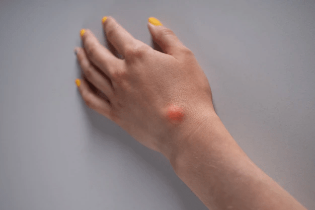 Natural Treatment for Hives