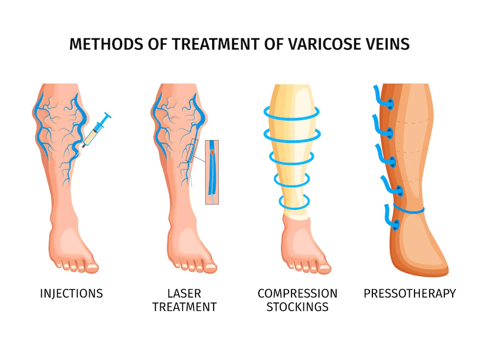 Effective Treatment Options for Varicose Veins: Seeking Professional Care