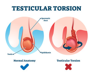 Testicular Torsion Home At Home