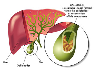 Gallstone: why peddle-like material will form in the gallbladder?