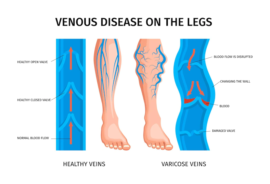 Introduction to Varicose Veins