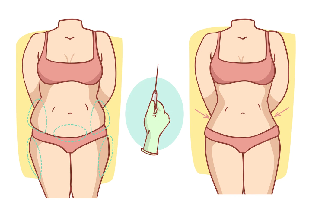 cost of liposuction

