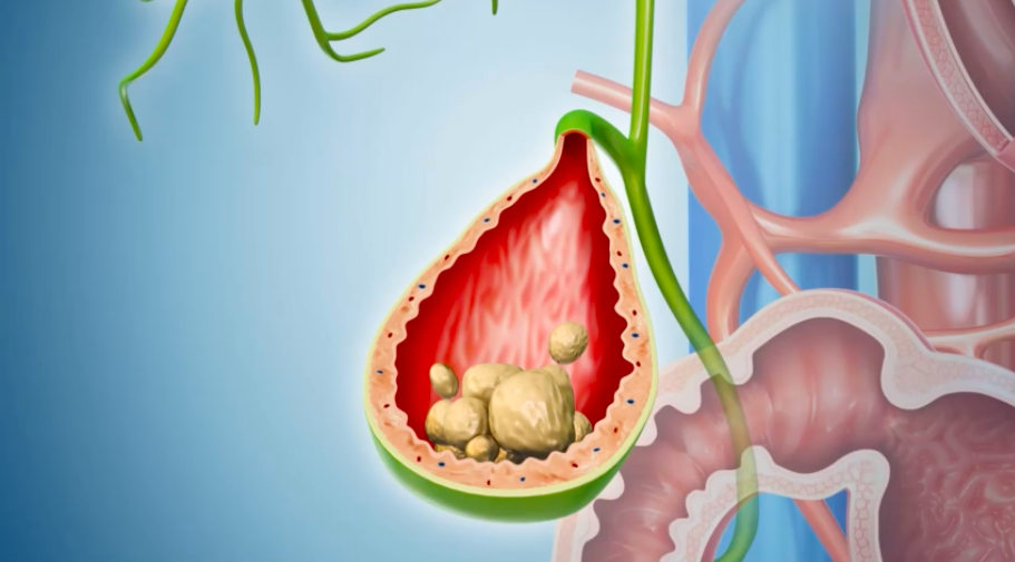 gallbladder sludge meaning