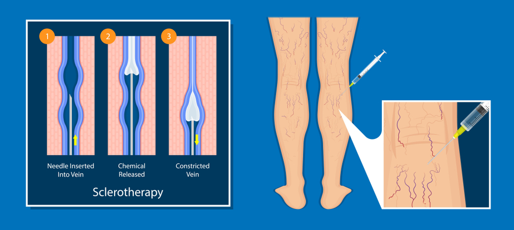 Sclerotherapy Meaning