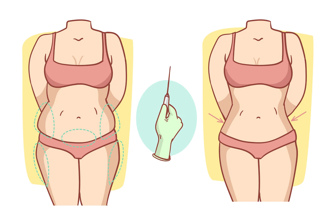 Liposuction Meaning in Hindi