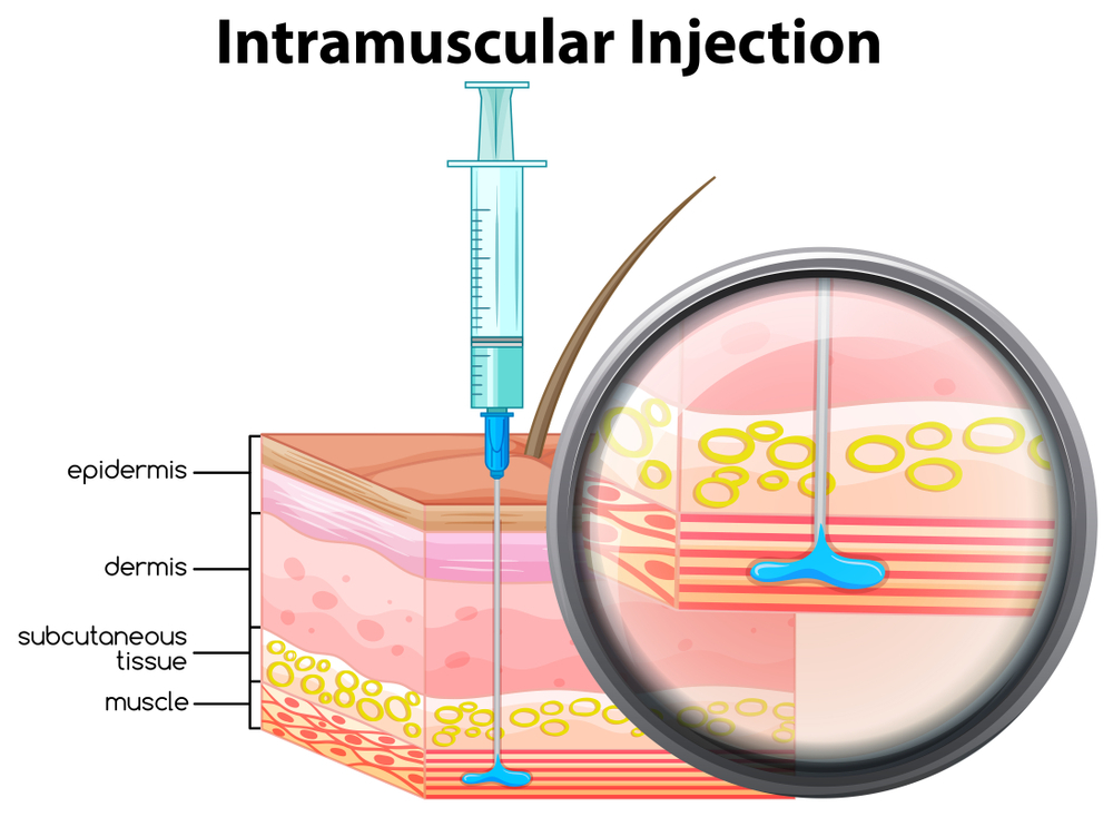 Side Effects of IM Injection