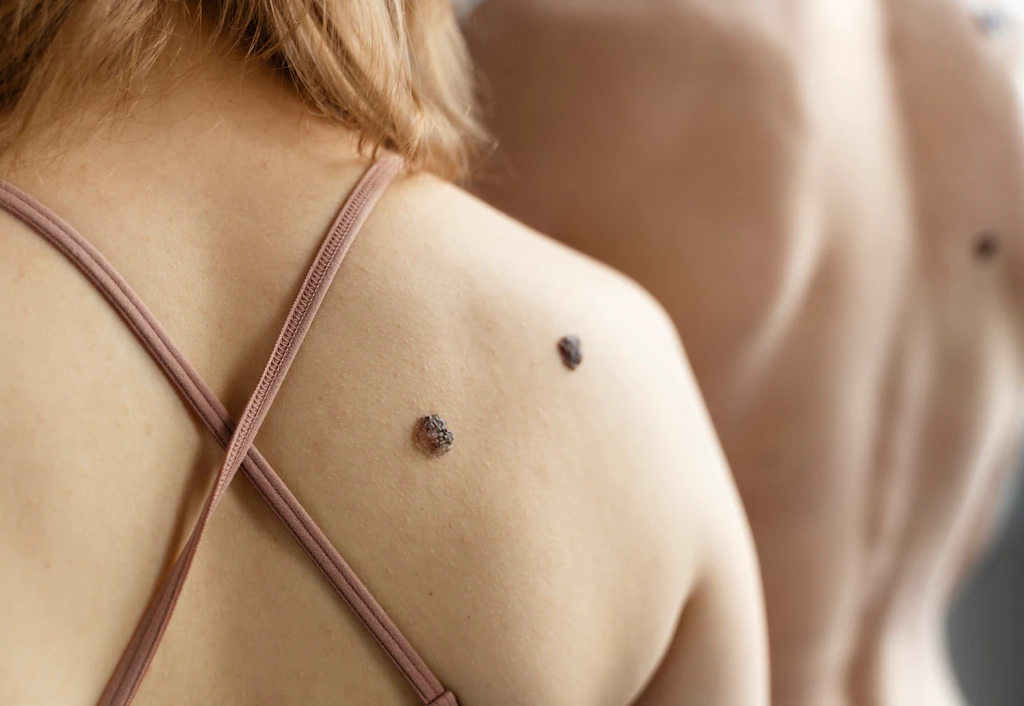Skin Tag Meaning