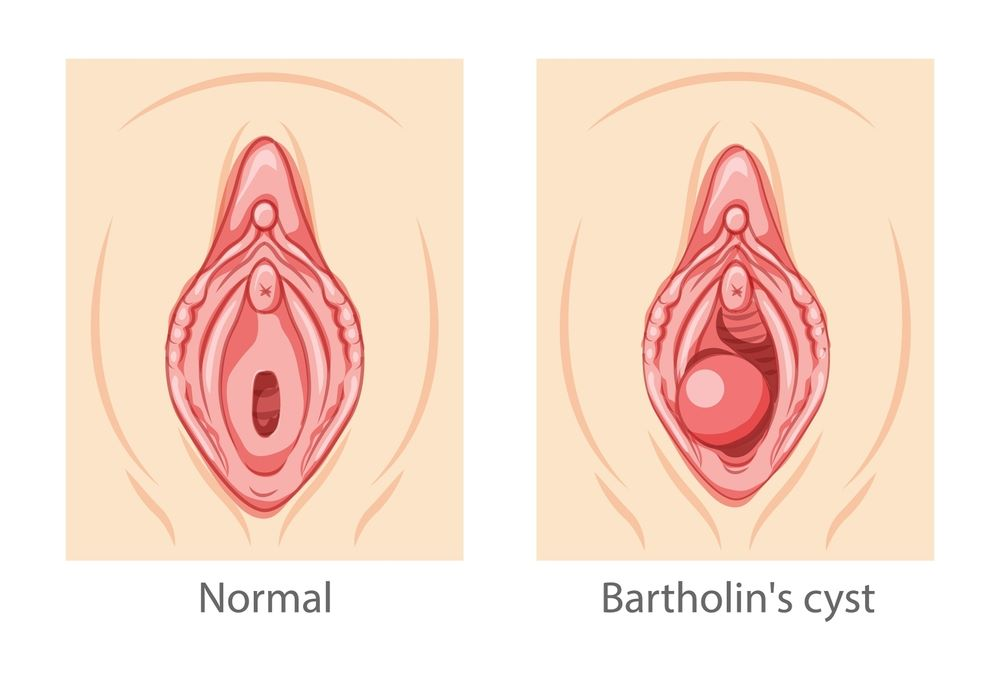 Bartholin Cysts